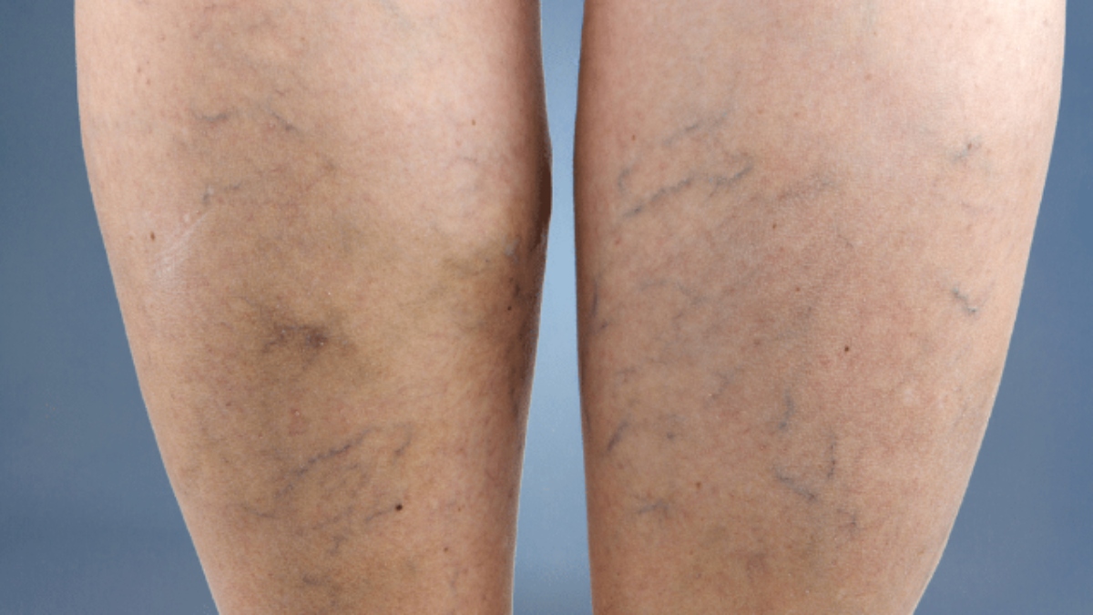 Swelled nerves? It can be cause of varicose veins, know symptoms and treatment