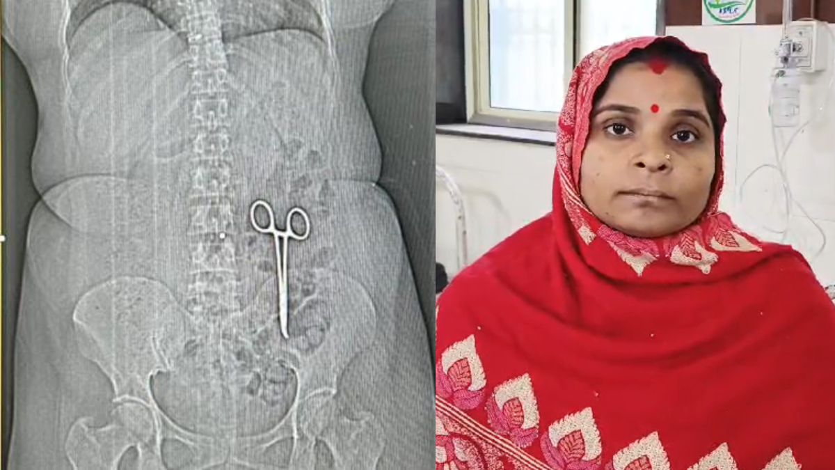 Doctors leave scissor inside woman's body during cancer treatment, only to find out 2 years later