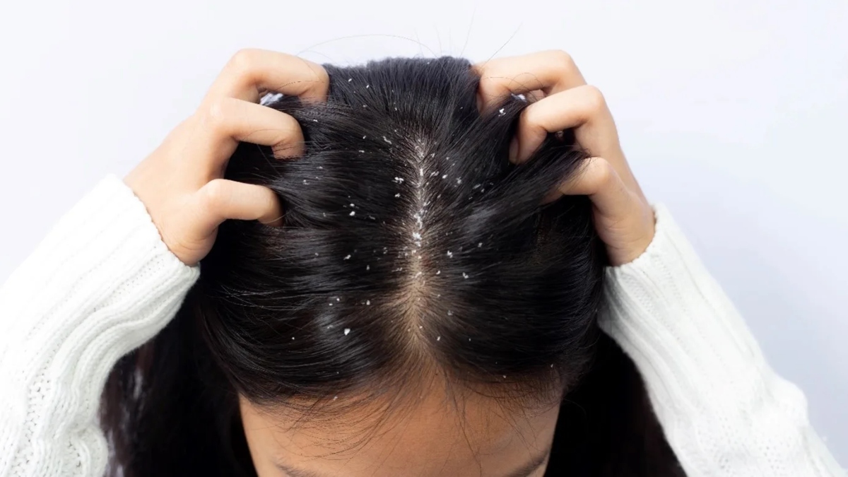 Fed up with Dandruff during winter? Adopt THIS Ayurvedic remedy to get rid of it