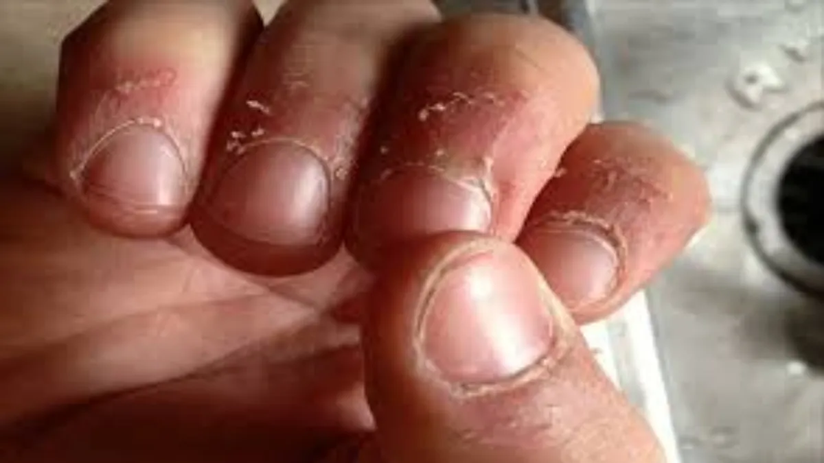 Is skin around your nails peeling off in winter Try THESE home remedies to treat and get instant relief India TV