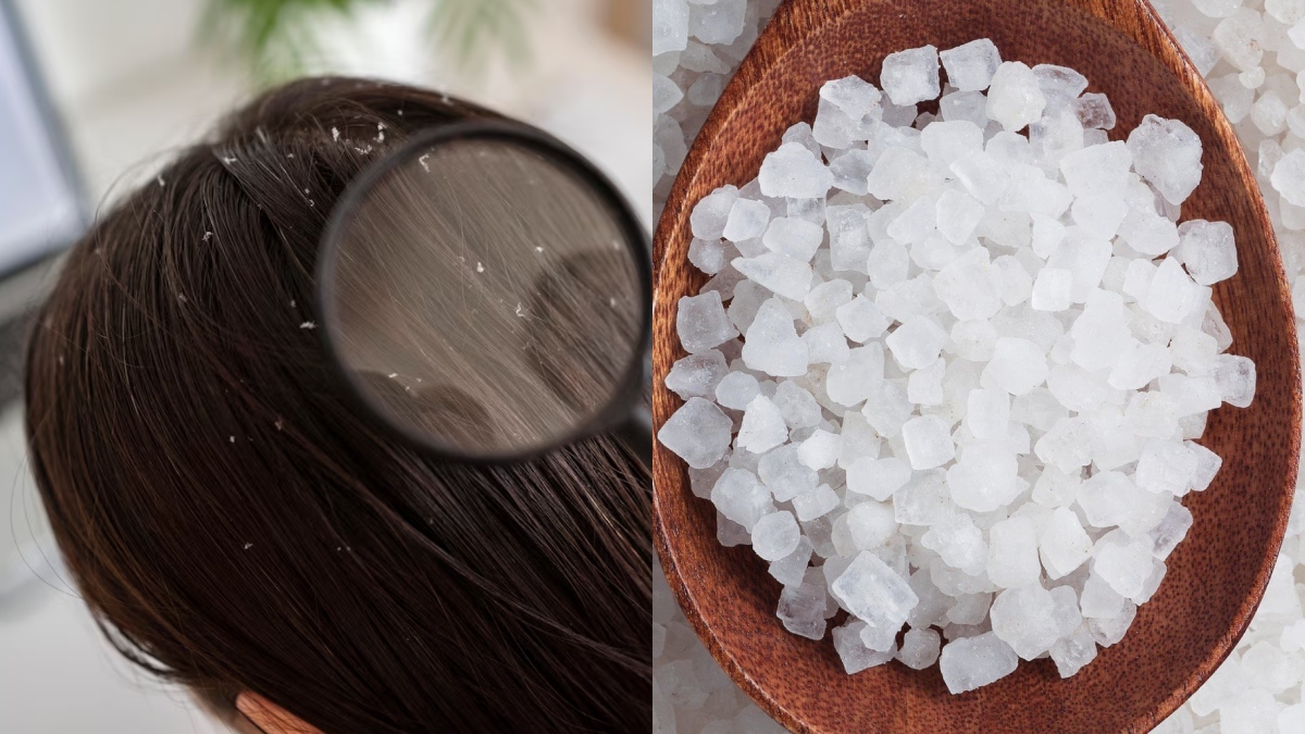 Dandruff issue during winter? Use THIS ingredient to get rid of flakes from hair