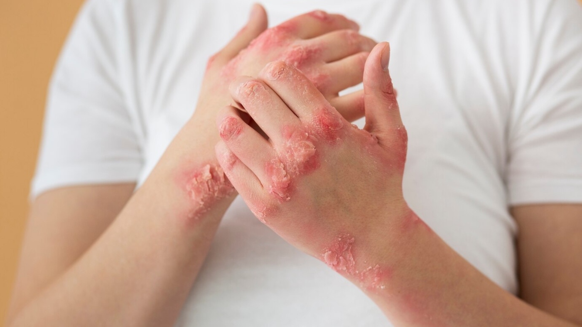 Why does psoriasis bother more in winter? Expert explains causes and treatment