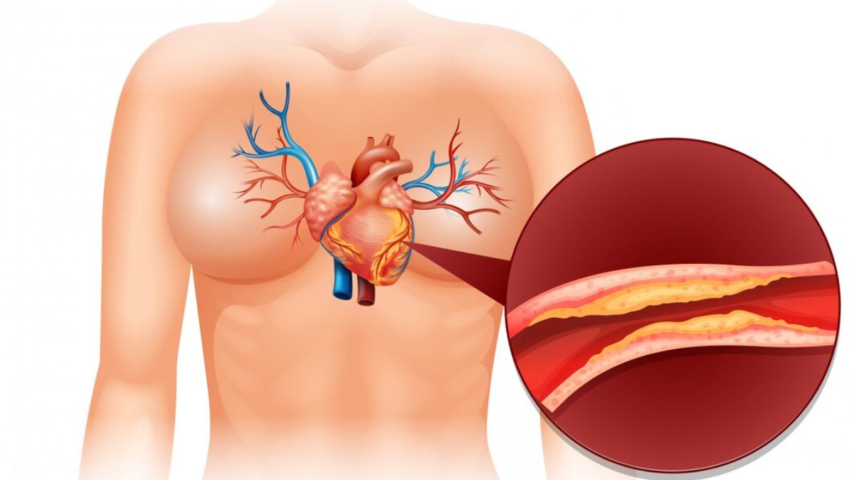 Cholesterol side effects: Know what happens to your body when you have high LDL