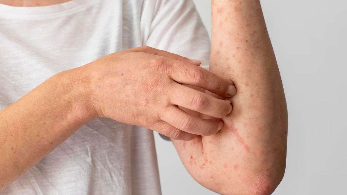 seasonal skin allergies know why pollens cause skin irritation in some people