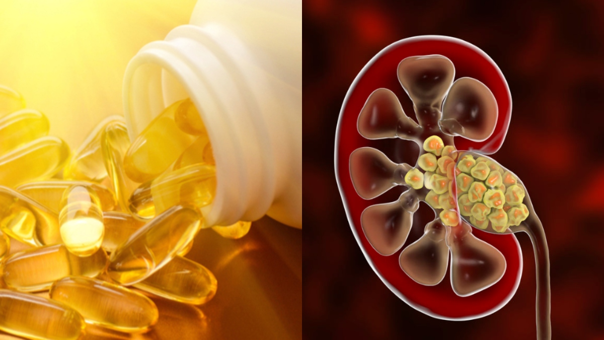 Do excess vitamin D supplements lead to kidney stones? Know risks and prevention strategies