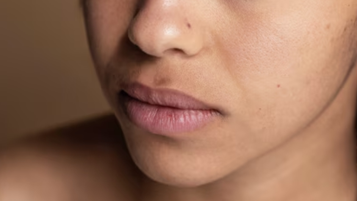 lifestyle hyperpigmentation around mouth try this easy home remedy to get rid of dark spots