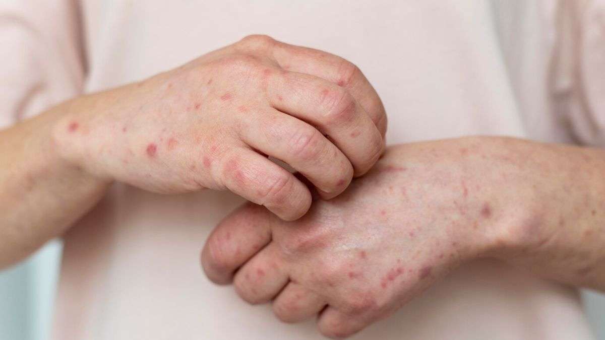 health measles outbreak texas 24 cases of the infection reported here s what you should know