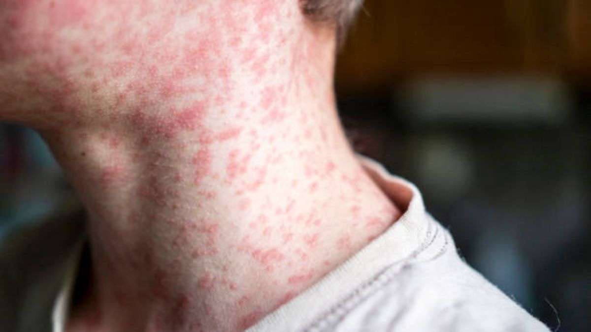 Measles outbreak Texas: 90 cases confirmed; symptoms and preventive measures