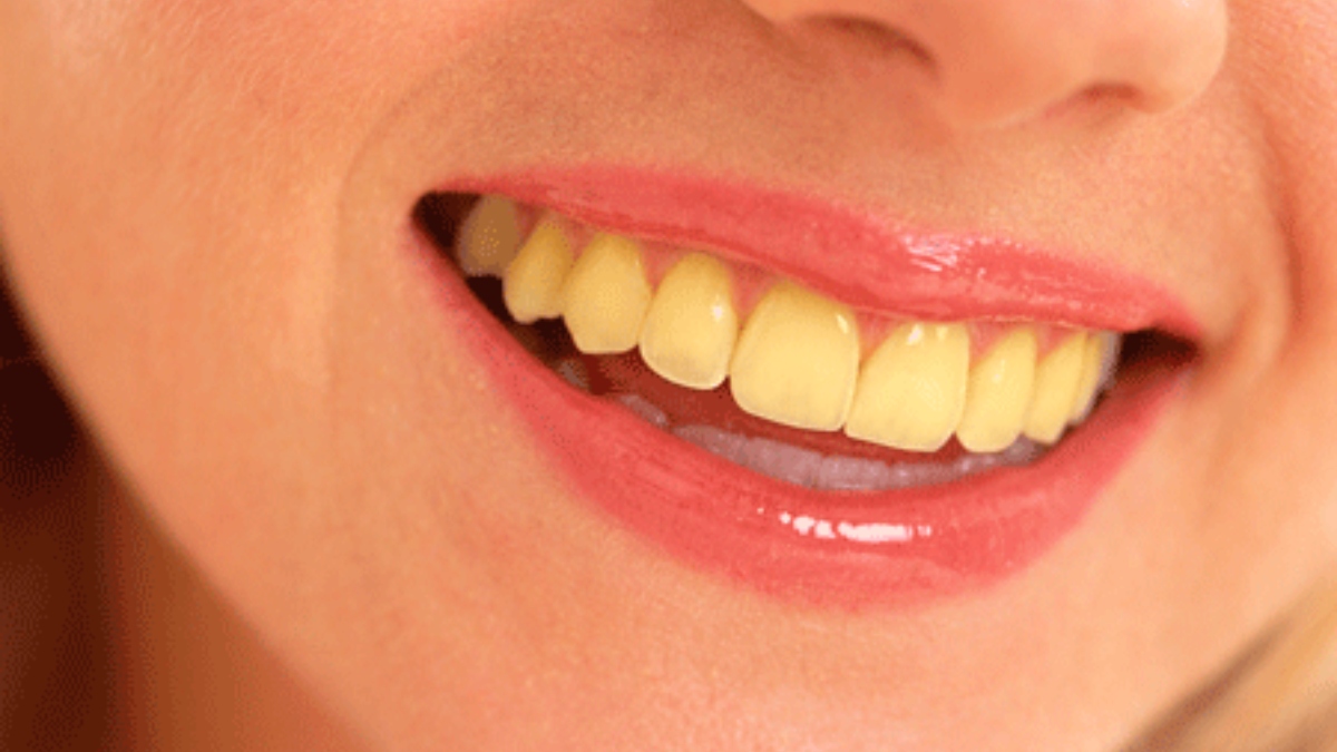 Ashamed of yellow teeth? Make them shine like pearls with these easy home remedies