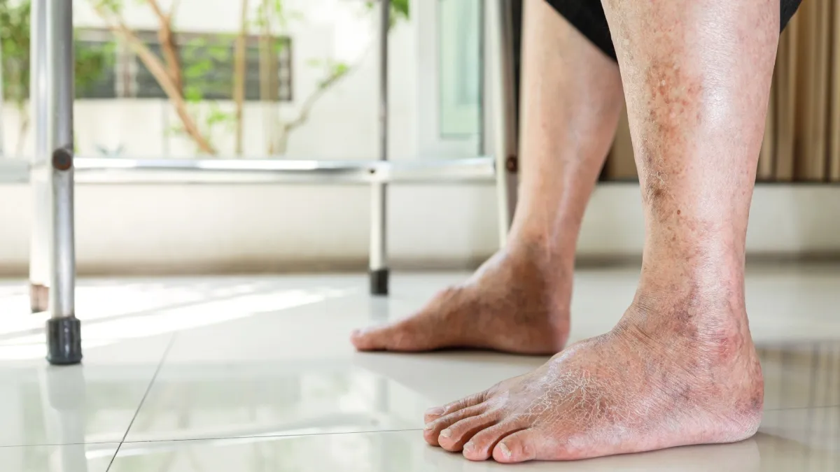 What is Peripheral Artery Disease (PAD)? 