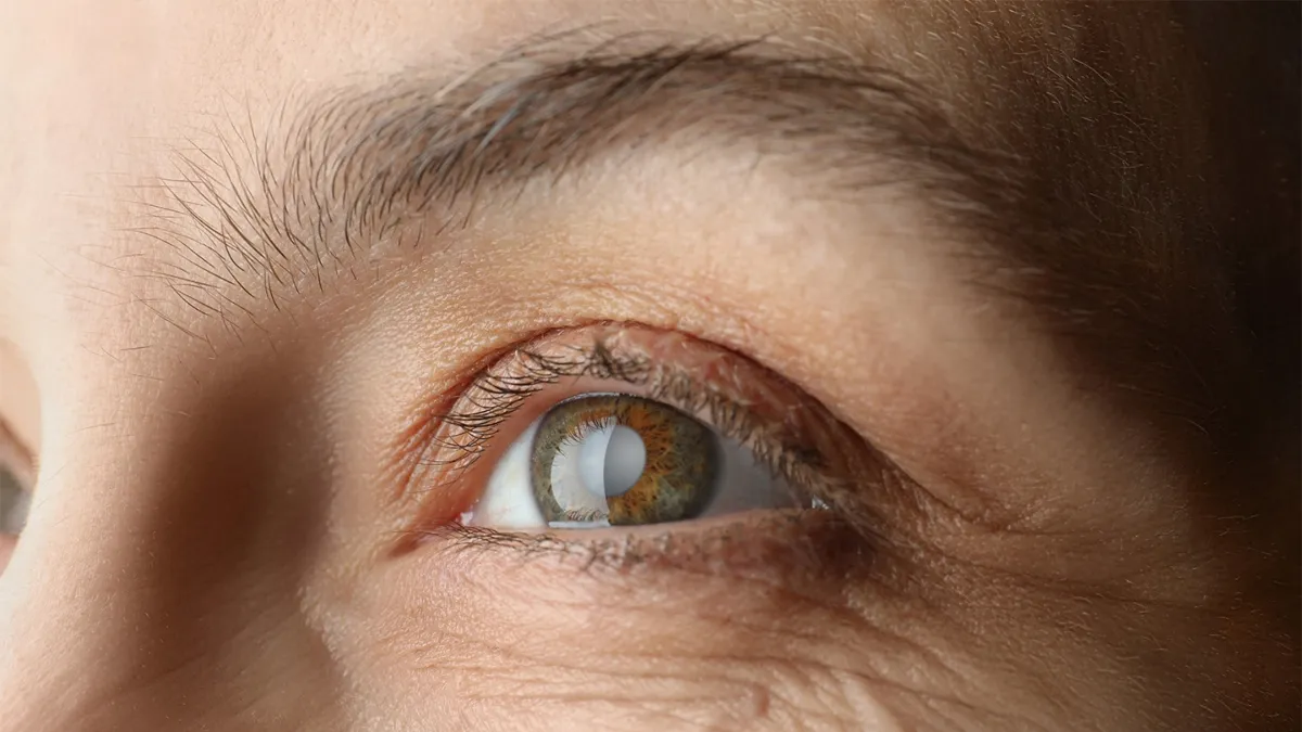 Cataract: Expert shares common eye problems 