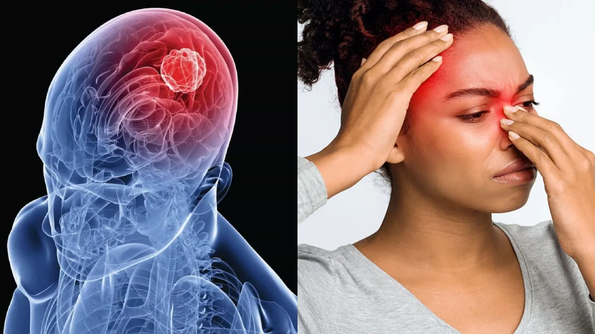 What tumour shows symptoms similar to chronic sinusitis?