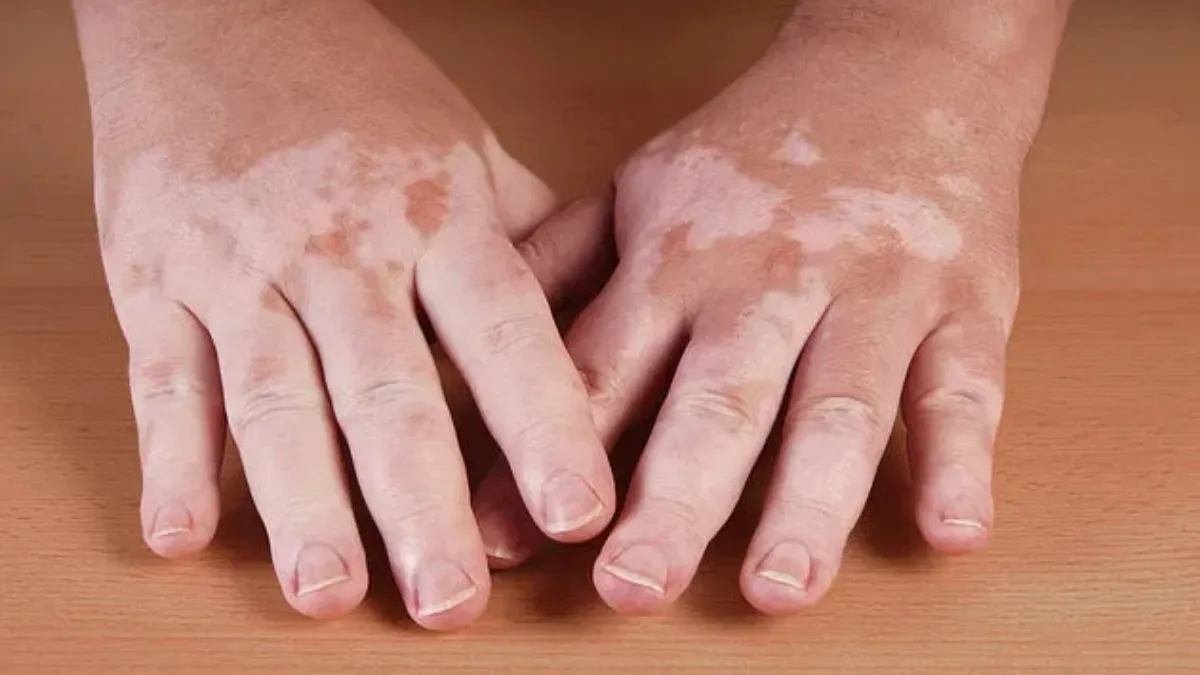World Vitiligo Day 2025: What is Vitiligo? 