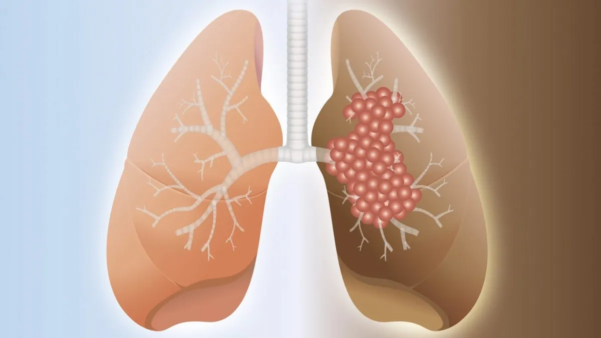Doctor debunk myths about pulmonary fibrosis