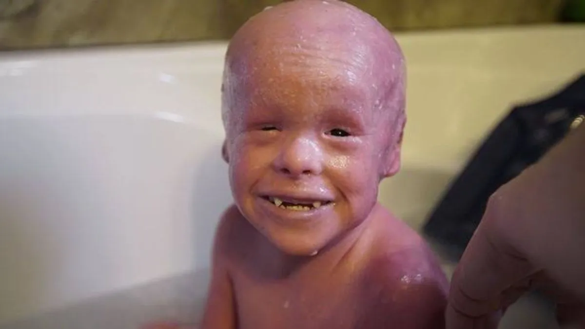 Harlequin Ichthyosis symptoms in newborns explained