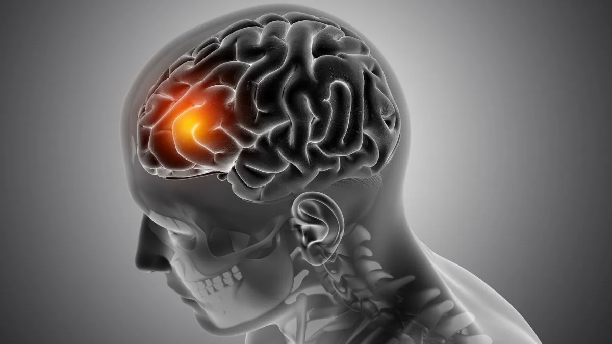 Brain haemorrhage symptoms, causes and more