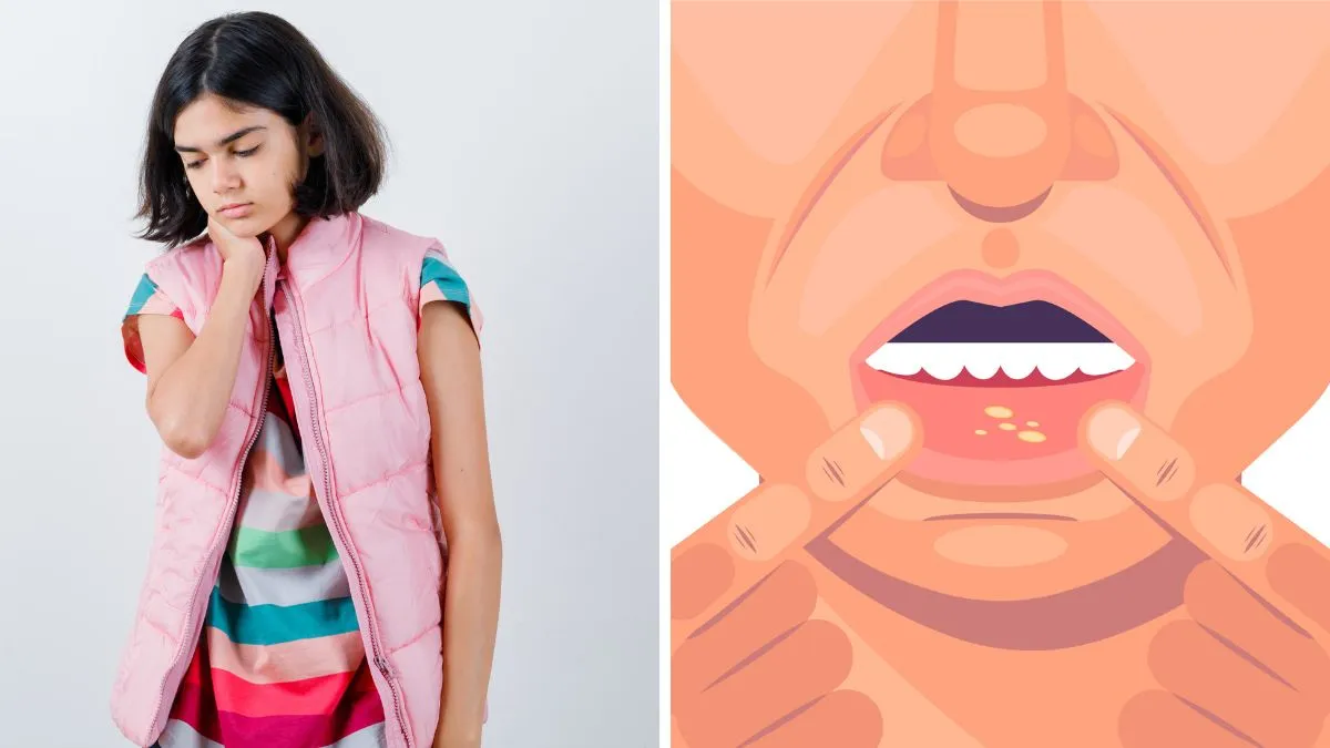 Hand, Foot and Mouth Disease: Symptoms, prevention and treatment