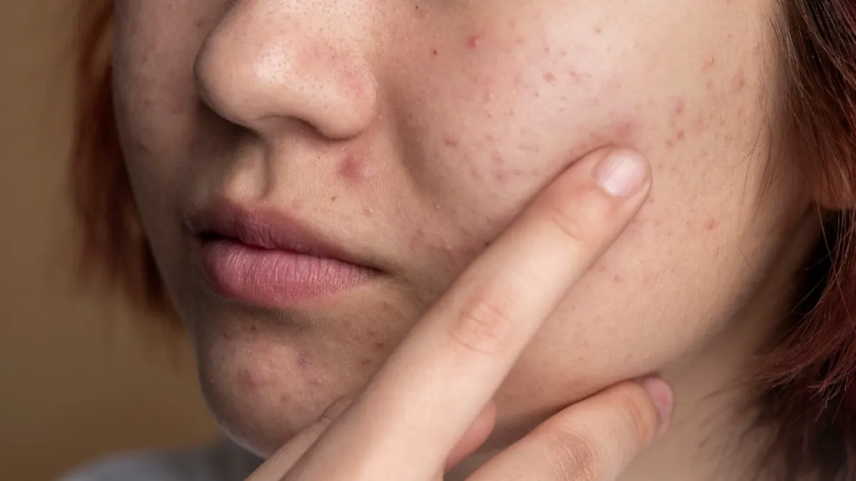 Close-up of facial acne showing pimples and skin inflammation, a common skin concern linked to multiple health and lifestyle factors.