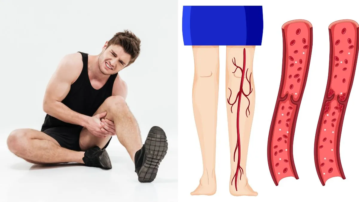 What is thrombosis? How to spot the warning signs early