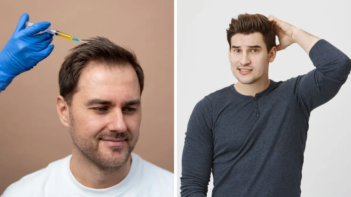 The silent makeover: Why Indian men are secretly getting hair transplants in their 30s