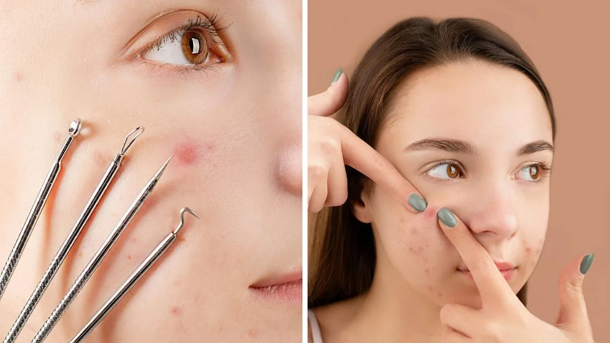 Acne-prone teens beware: winter air and pollution create the perfect storm for breakouts