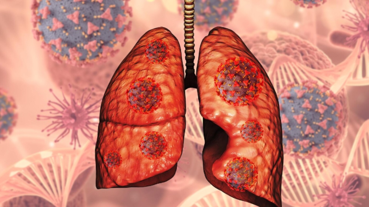 गैर-धूम्रपान करने वालों में फेफड़ों का कैंसर: जल्दी पहचानें