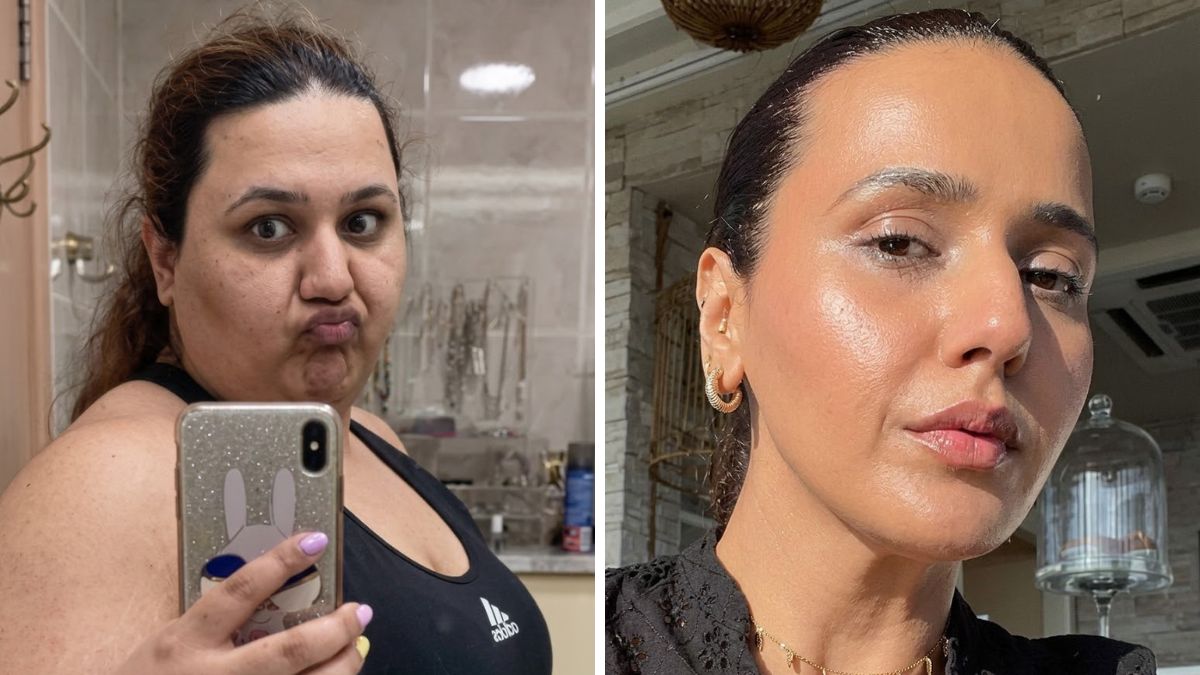 PCOS Reversal and Weight Loss: Lifestyle Changes Lead to Dramatic Skin Transformation