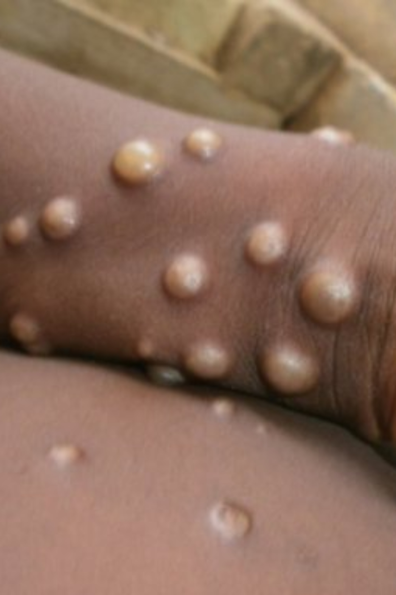 5 Food items that will help in Monkeypox recovery 