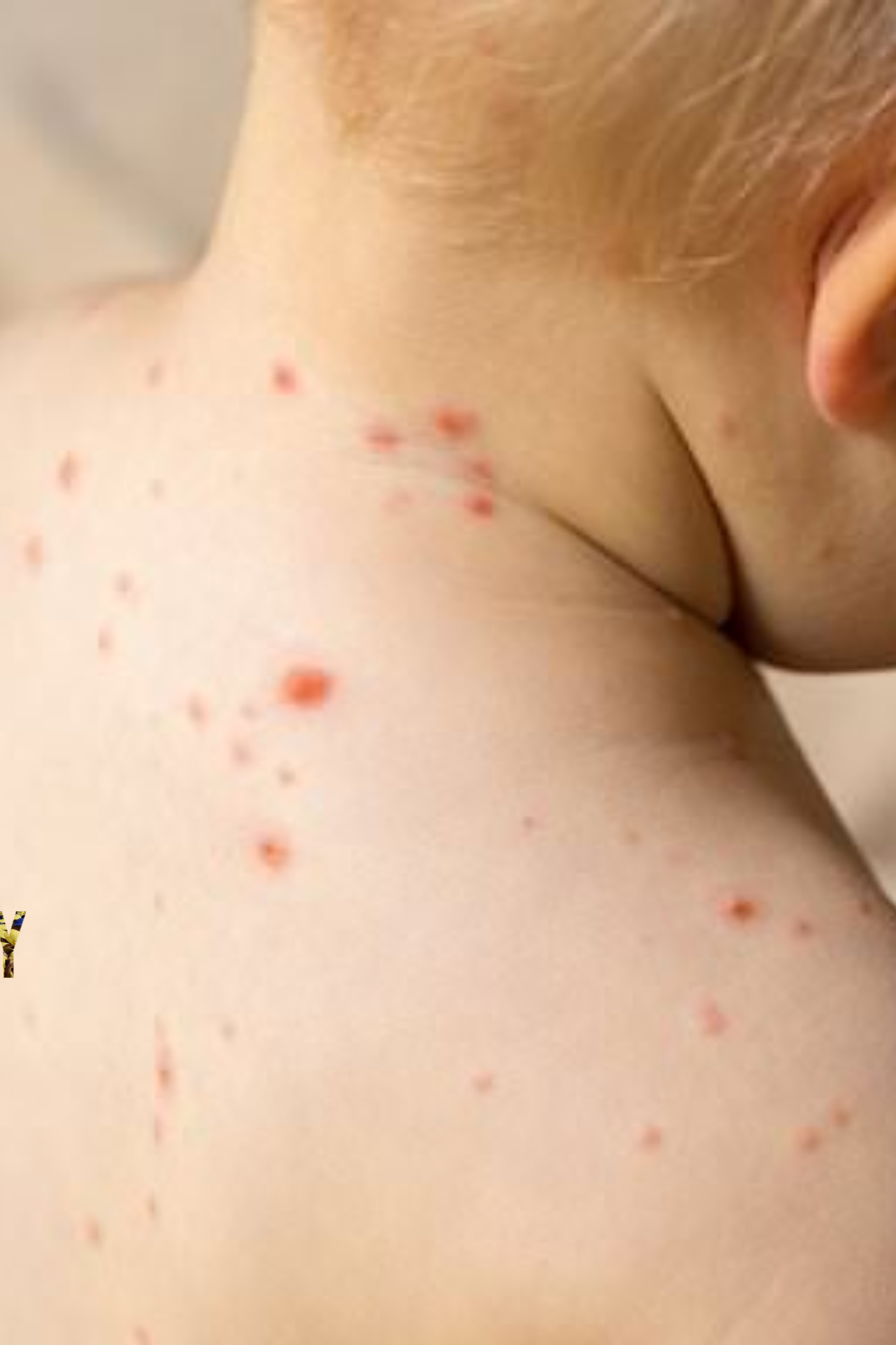 The infection causing red round blisters on the skin of children below the age of five is called Tomato flu. 