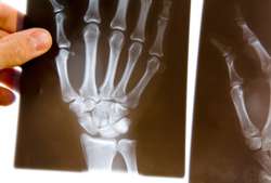 Arthritis Patients, Symptoms, Kids