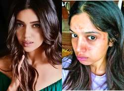 Bhumi Pednekar gets burn marks on face during Saand Ki Aankh shoot