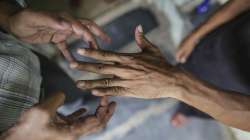 World Leprosy Day 2022, Stigma, ostracisation, rotary club 