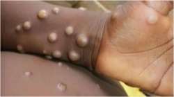 monkeypox virus