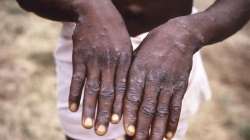 kerala man, monkeypox