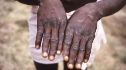 monkeypox, monkeypox case, monkeypox virus