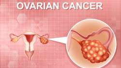 ovarian cancer treatment