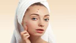 Try these five simple and effective natural acne treatments at home