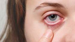 Glaucoma: Warning Signs