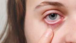 types of Conjunctivitis