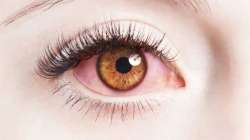 Conjunctivities or eye flue, Conjunctivities, Cases of conjunctivitis, delhi schools advisory