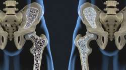 Low Bone Density