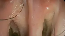 Australian man developed hair inside throat