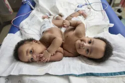 conjoined twins, Amari and Javar Ruffin, at the Children’s Hospital of Philadelphia, March 20, 2024