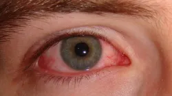 bleeding eye virus