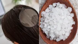 dandruff with camphor