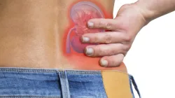 Kidney stones play havoc on your back