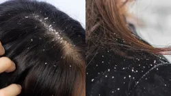 dandruff 