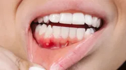 mouth ulcers