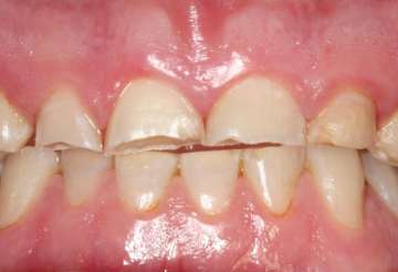 4 reasons why biting your nails can also damage your teeth | Sloan Dental