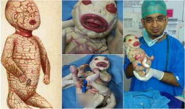Harlequin baby dies two days after birth